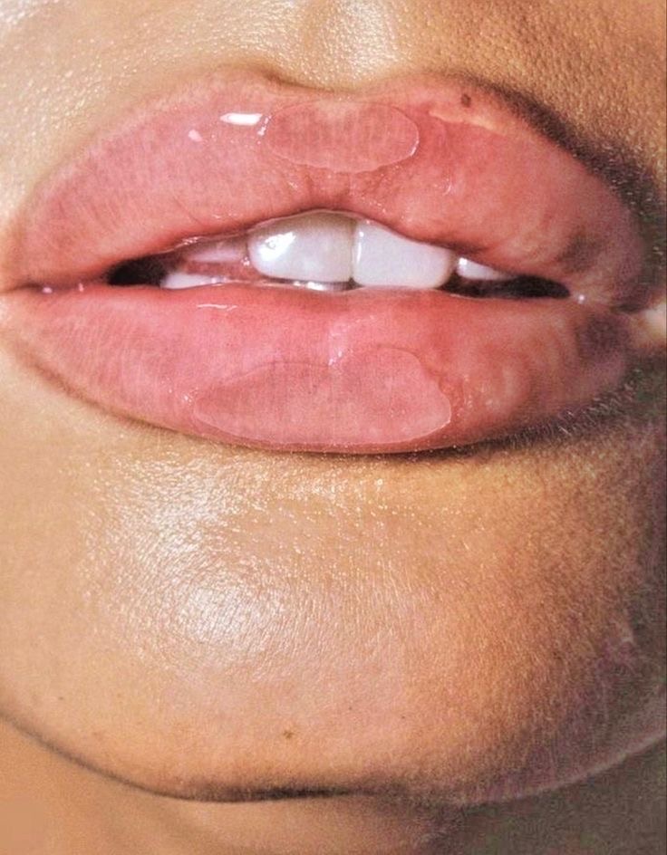 Natural lip filler results