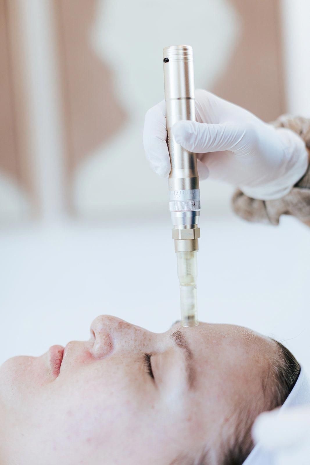 PRP facial rejuvenation treatment